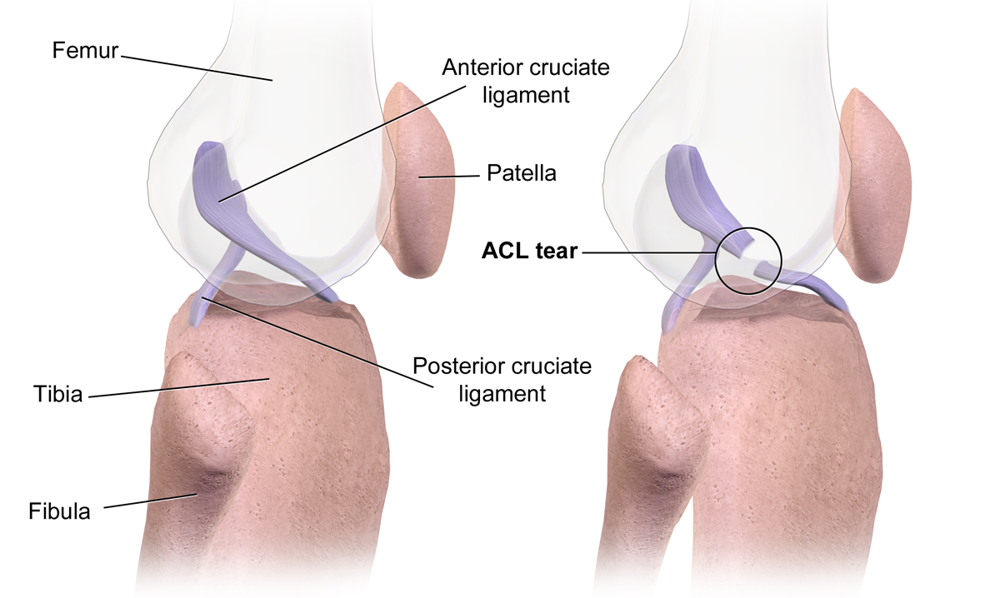 Footballers Community | Understanding the ACL Injury